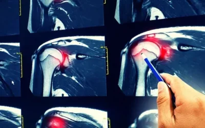 Benefits of PRP (Platelet Rich Plasma) For Rotator Cuff Tears